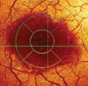 Retina Systoid Macular Edema CME Reflective Map