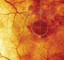 Retina Diabetc Malular Edema DME Relectance Map