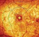 Retina Macular Hole Reflectance Map